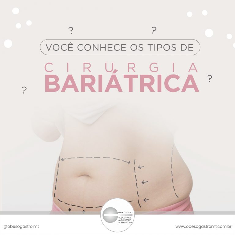Leia mais sobre o artigo Você conhece os tipos de Cirurgia Bariátrica?